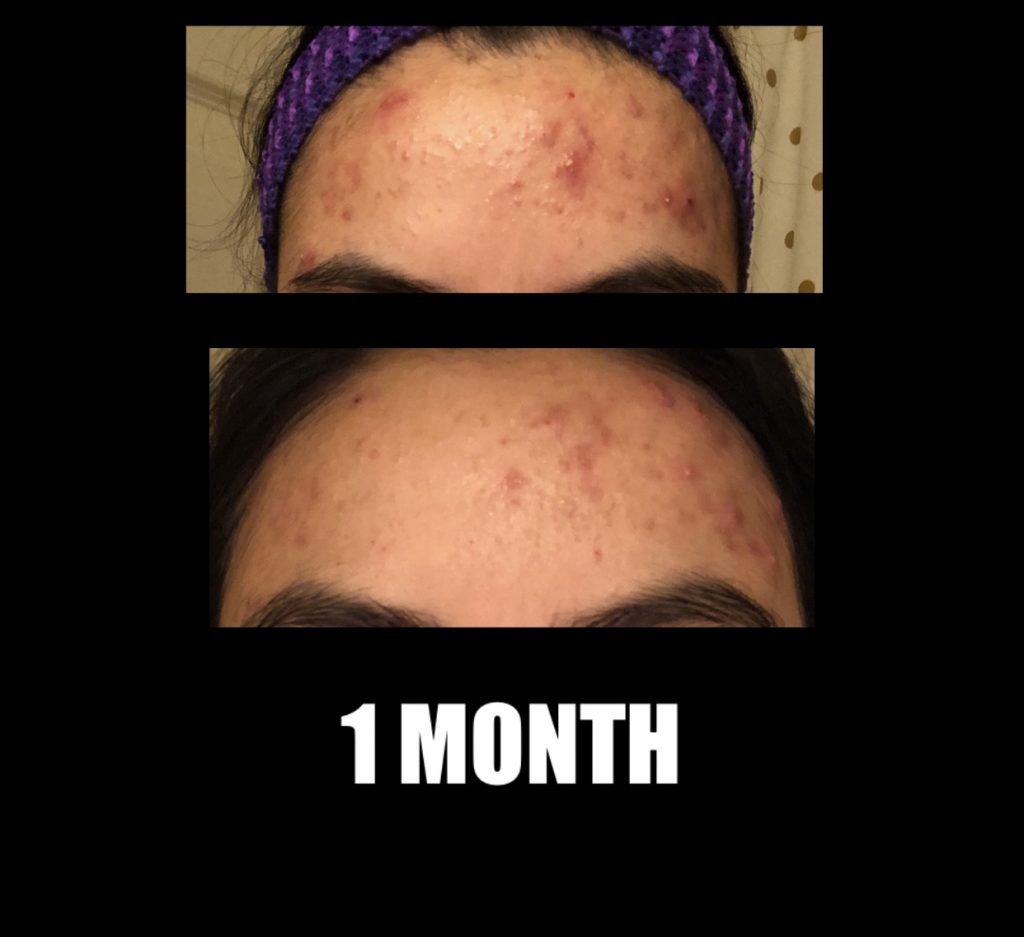 Results of skin care products malassezia acne